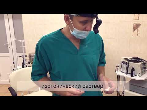 Видео: Вазотомия носовых раковин радиоволной. Реабилитация, рекомендации.