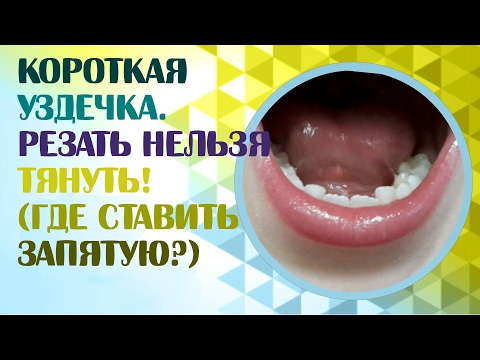Видео: Короткая уздечка языка или короткая подъязычная уздечка.Нужно ли подрезать короткую уздечку?