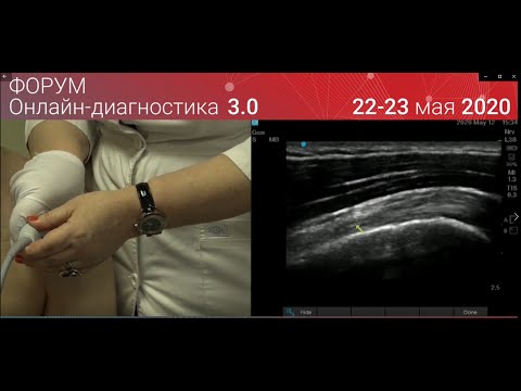 Видео: УЗИ плечевого сустава — просто о сложном