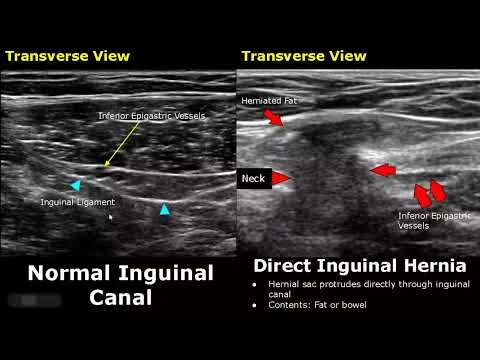 Видео: УЗИ грыж: нормальные и патологические изображения | Прямое/непрямое УЗИ паховой/эпигастральной/бе...