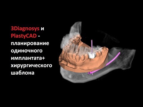 Видео: 3Diagnosys и PlastyCAD - планирование одиночного имплантата+ хирургического шаблона