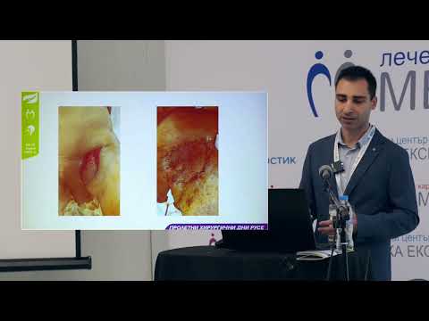 Видео: 58. Венозна стаза при педикулирани ламба за реконструкция на комплексни кожни дефекти...
