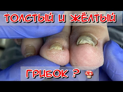 Видео: Толстый и Желтый ноготь / Грибок ногтей, что Делать? /Грибок на ногах /Грибы /Грибок ногтей на ногах