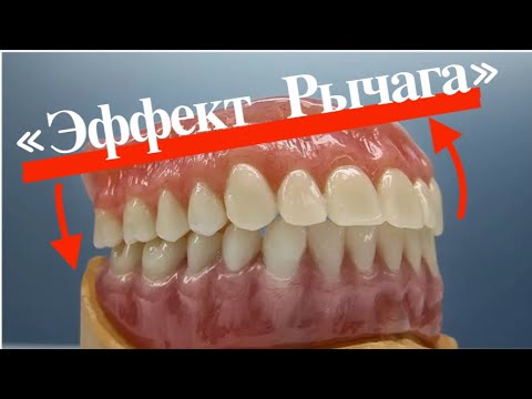 Видео: Почему Спадают Полные Съёмные!? «Эффект Рычага» #протезированиезубов #протезирование #стоматология