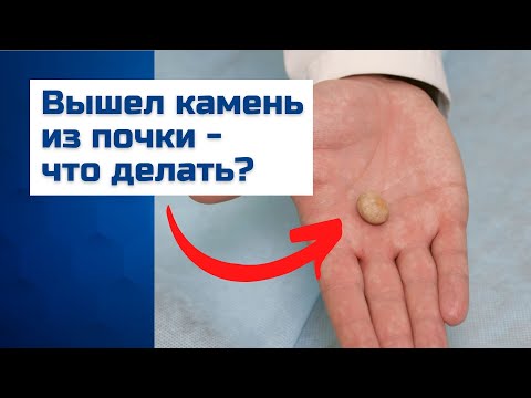 Видео: Вышли камни из почки? Анализ камня почки и метафилактика