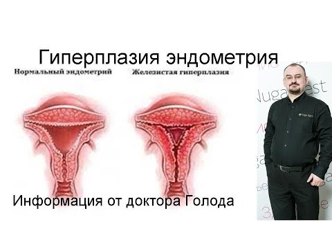 Видео: Гиперплазия эндометрия - ответ от доктора Голода