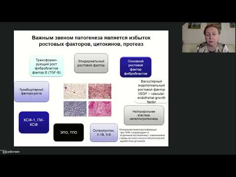 Видео: Миелофиброз: изменение прогноза в связи с появлением инновационных препаратов.