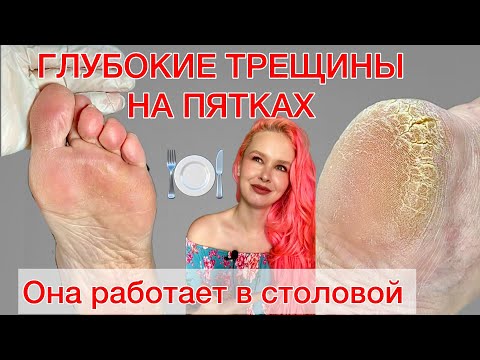 Видео: ОНИХОЛИЗИС | ТРЕЩИНЫ НА ПЯТКАХ | СТЕРЖНЕВАЯ МОЗОЛЬ | АНАЛИЗ ОБУВИ #алена_лаврентьева #подолог