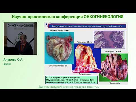 Видео: Дифференциальная диагностика муцинозных опухолей яичников