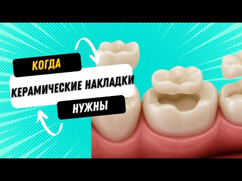 Видео: Керамические накладки на зубы. Когда пломбы уже не достаточно. 