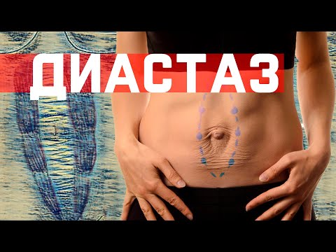 Видео: Диагностика Диастаза. Что можно делать? Что нельзя?