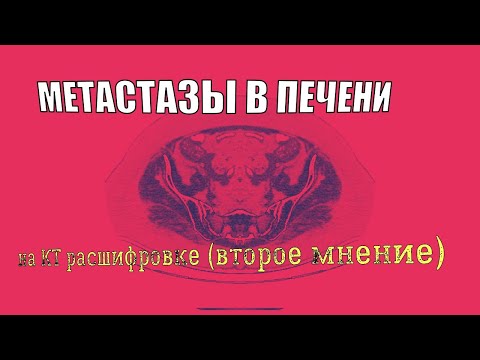 Видео: Поражение печени.  ОЧАГИ в печени на КТ РАСШИФРОВКЕ брюшной полости. МЕТАСТАЗЫ в печени (симптомы).