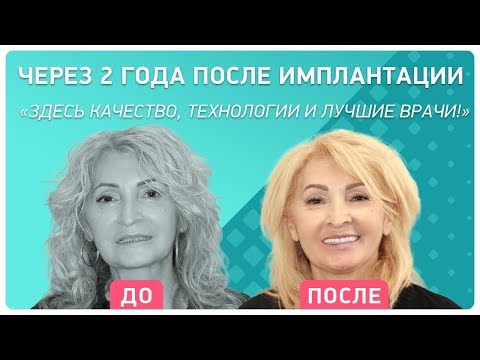 Видео: Отзыв через 2 года после установки имплантов в Smile at Once