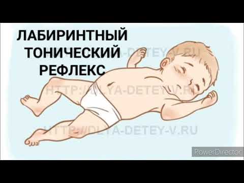 Видео: Лабиринтный тонический рефлекс. Нарушение осанки, координации, косоглазие. ДЦП