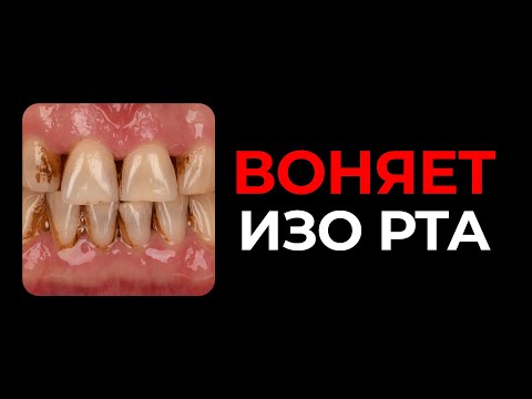 Видео: Ужасный запах изо рта. Из-за чего?