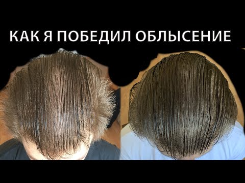 Видео: КАК Я ПОБЕДИЛ ОБЛЫСЕНИЕ | ЧТО ДЕЛАТЬ ЕСЛИ ЛЫСЕЕШЬ
