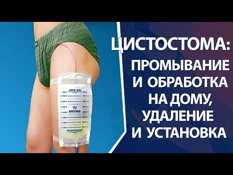 Видео: Цистостома: замена и промывание цистостомы на дому и в клинике, установка и удаление цистостомы