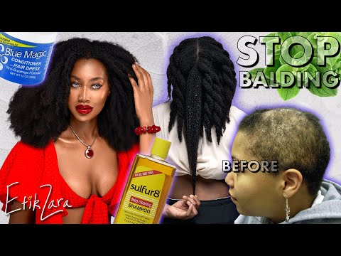 Видео: ОСТАНОВИТЕ #ОБЛЫСЕНИЕ и #АЛОПЕЦИЮ с помощью этих 7 ЧУДЕСНЫХ СПОСОБОВ ДЛЯ РОСТА ВОЛОС | EfikZara #...