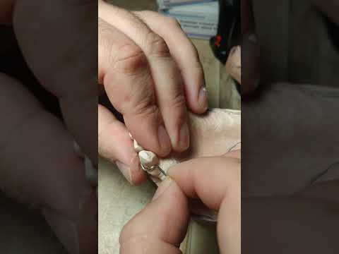 Видео: Съёмный зубной протез. Часть 4. Кламмера