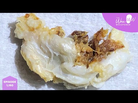 Видео: 1150 - Удаление сложного обтурирующего кератоза III степени