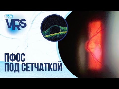 Видео: Осложнения хирургии отслойки сетчатки | Перфторорганическое соединение под сетчаткой