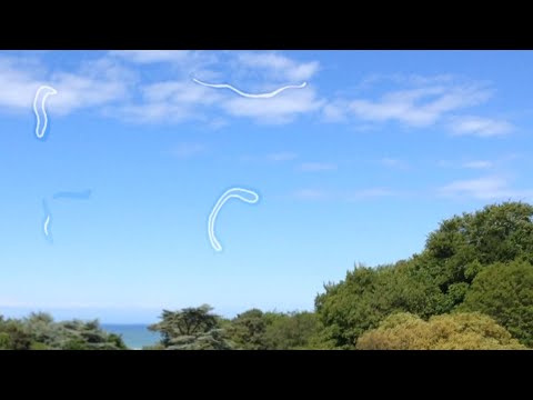 Видео: Витреолизис. Удаление мушек перед глазами