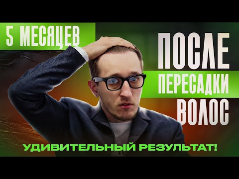 Видео: ШОК. 5 месяцев после пересадки волос в Турции. Вот это результат!
