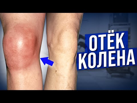 Видео: Как убрать ОТЕК колена без таблеток и мазей? Упражнения от отека коленного сустава!