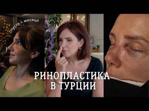 Видео: Долго об этом мечтала! Ринопластика спустя 4 месяца - об этом многие молчат