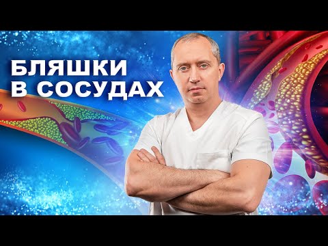 Видео: Атеросклеротические бляшки – можно ли их убрать?