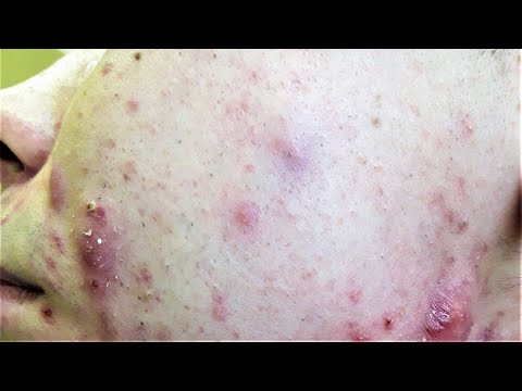 Видео: Таргетная терапия АКНЕ (профессор Самцов А.В.)