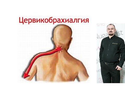 Видео: Цервикобрахиалгия – боль в шее с распространением в руку.