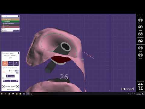 Видео: 8  Абатмент Винтовая фиксация Инвидуальный абатмент с коронкой