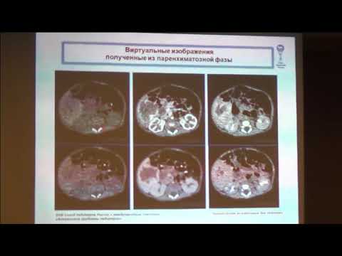 Видео: 17.02.2017 - Новые возможности компьютерной томографии: двухэнергетическое сканирование