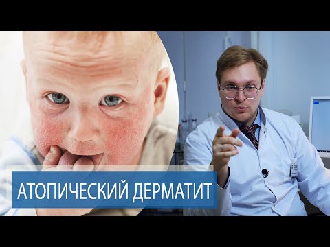 Видео: АТОПИЧЕСКИЙ ДЕРМАТИТ | Как лечить ДИАТЕЗ