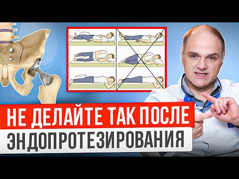Видео: 5 ограничений после замены тазобедренного сустава. Ваша жизнь измениться после эндопротезирования.