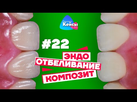 Видео: Эндо, отбеливание, композит  | Дентал Кейсы от BG #22