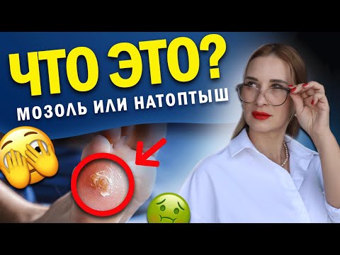 Видео: ВАША НОГА КРИЧИТ О ПОМОЩИ!! Какие опасности скрывает стержневая мозоль...