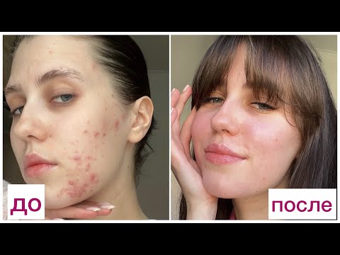 Видео: КАК ИЗБАВИТЬСЯ ОТ ПРЫЩЕЙ 😭 УЖАСЫ ЛЕЧЕНИЯ АКНЕ: Системные ретиноиды, побочки, дерматит и чистая кожа