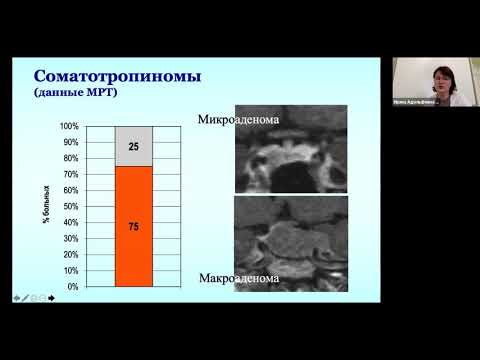 Видео: Диагностика акромегалии