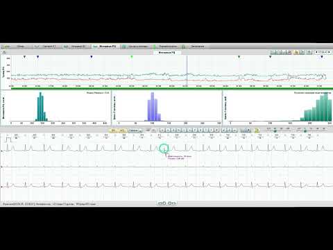 Видео: Измерения интервала PQ в "Валенте" (ответ на вопрос в комментариях)