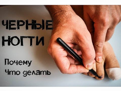 Видео: Черные ногти у бегунов. Почему и что делать