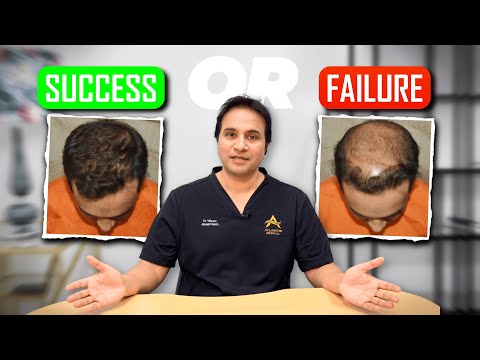 Видео: Прежде чем сделать пересадку волос, ПОСМОТРИТЕ ЭТО!