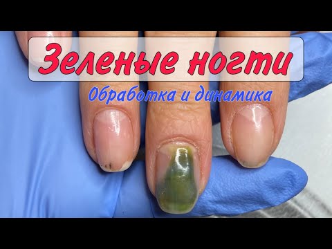 Видео: Зеленые ногти/ синегнойка под ногтями/ синегнойная палочка