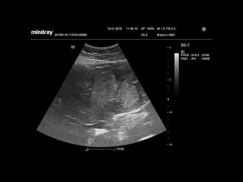 Видео: Ультразвуковая диагностика. Доктор Иогансен. Видеопримеры. Выпуск 2. Метастазы в печени. Часть 2.