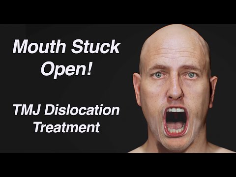 Видео: Рот застрял открытым! Лечение вывиха ВНЧС