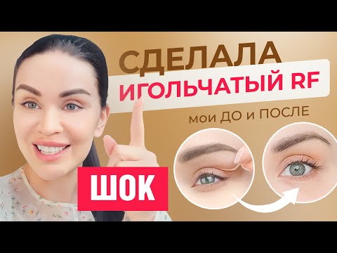 Видео: ИГОЛЬЧАТЫЙ RF ЛИФТИНГ. МОИ РЕЗУЛЬТАТЫ. КАК УБРАТЬ МОРЩИНЫ ВОКРУГ ГЛАЗ?