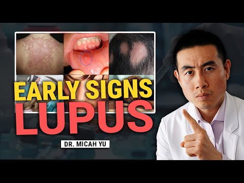 Видео: 5 ранних признаков волчанки, которые большинство врачей упускают из виду