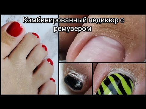 Видео: КОМБИНИРОВАННЫЙ педикюр с РЕМУВЕРОМ❤️/что-то с пальцем🆘/классический КРАСНЫЙ в ОДИН слой🤩/Vogue