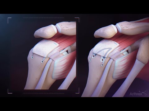 Видео: Система восстановления вращательной манжеты плеча CuffMend™